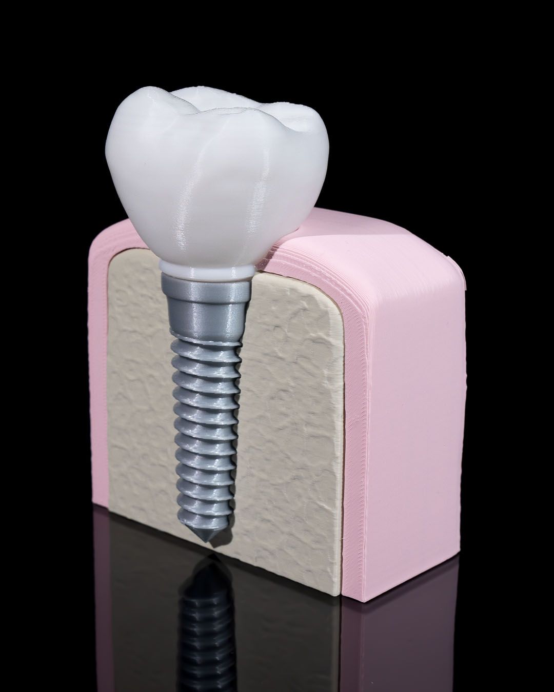 Dental Implant